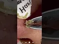 Skincare | Blackheads Removal #587 #tweezers skincare #blackheads blackheads