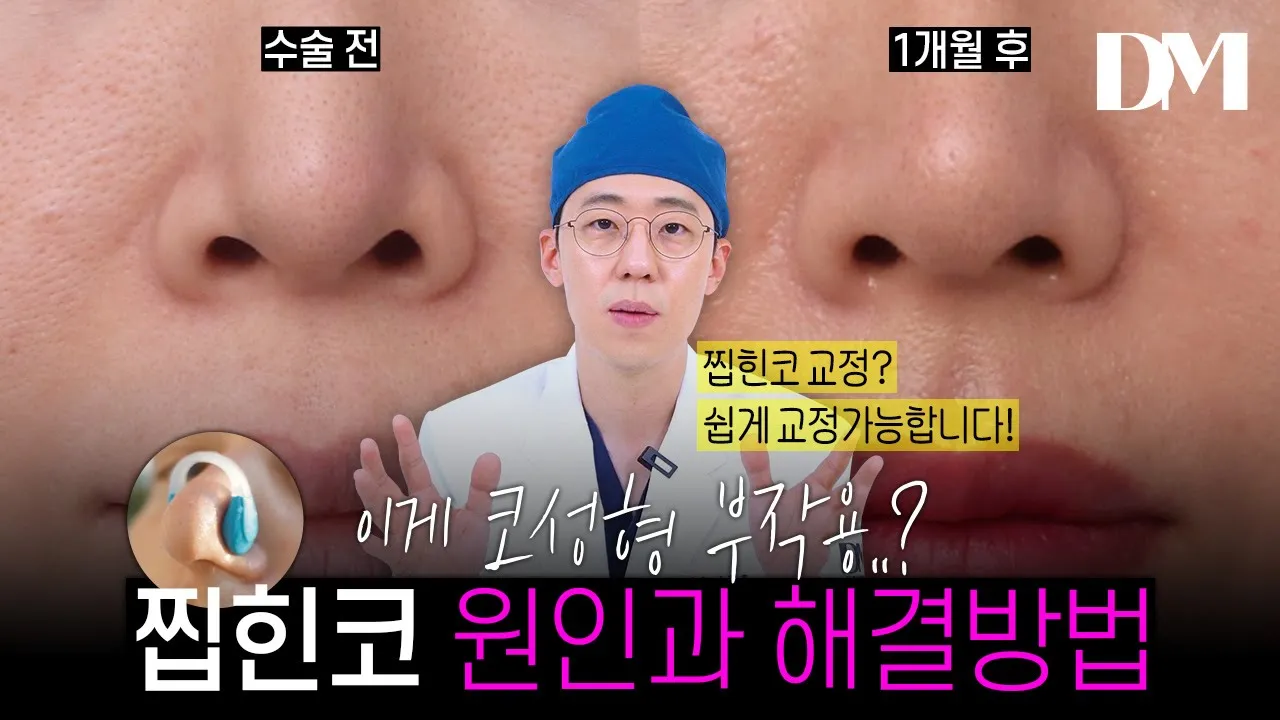 집게로 찝혀놓은 듯한 찝힌 코😥 어떻게 하지? #코성형 #찝힌코 #코성형 부작용