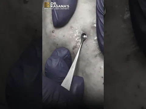 Blackheads Removal by Dr. Lalit Kasana #blackheads #blackheadsremoval