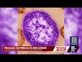 Measles cases surge to 15 in Iowa and Lafayette counties as Wisconsin warns of more spread