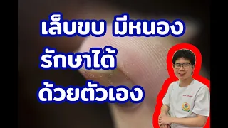 อาการของเล็บขบที่ไม่รุนแรงกับรุนแรงต่างกันอย่างไร