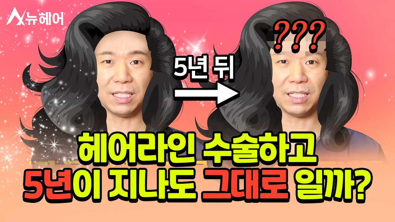 헤어라인 교정 수술 5년 뒤에도 그대로 일까?｜모발이식｜뉴헤어