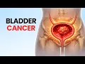 Lagu 10 Silent Symptoms of Bladder Cancer Many People Miss