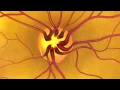 Animation Dilated Eye Exam