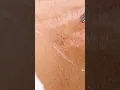 Download Lagu Up close view of how laser stretch mark removal works! 😯 #shorts