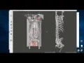 A ridiculously easy and free way to make 3D printable bones from CT scans