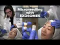 Why Exosome Microneedling is a Game-Changer for Skin Rejuvenation West End Plastic Surgery