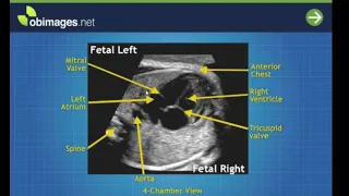 6 Step 6 The Left Ventricular Outflow Tract View Adjacent Anatomy 