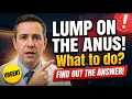 LUMP ON THE ANUS What to do Colorectal Surgeon Explains