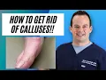 How to remove calluses from your feet Dr Nick Campitelli