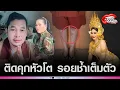Download Lagu คัดค้านประกันตัว'วัน มรณา'แถมสั่งปลดออกจากตำแหน่ง ติดคุกหัวโต รอยช้ำเต็มตัว