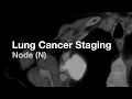 Lagu Lung Cancer Staging - Node (N)