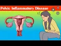 Pelvic Inflammatory Disease (PID) - Causes, Signs \u0026 Symptoms, Diagnosis, And Treatment