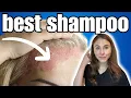 BEST Shampoo For Psoriasis Dermatologist Recommended