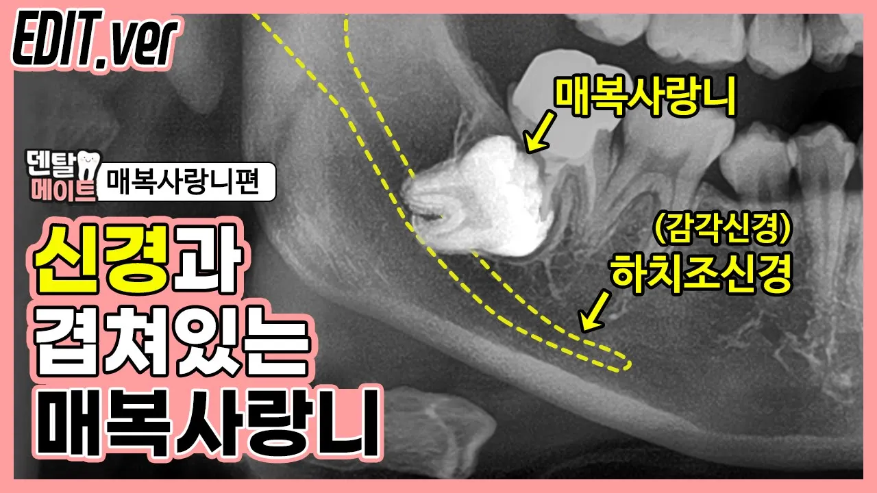 사랑니 발치와 안면마비(감각신경과 겹쳐있는 매복사랑니) | 덴탈메이트-매복사랑니 편집버전