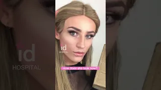 Amazing Facial Feminization Surgery Transformation