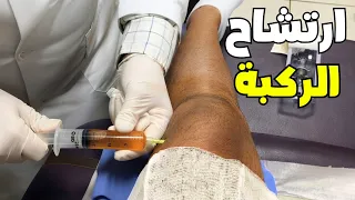 شاهد ماهو مرض ارتشاح الركبة؟! وكيف يتم علاجة _ knee effusion drainage
