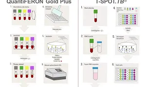 Download Interferon Gamma Release Assays (IGRAs) MP3