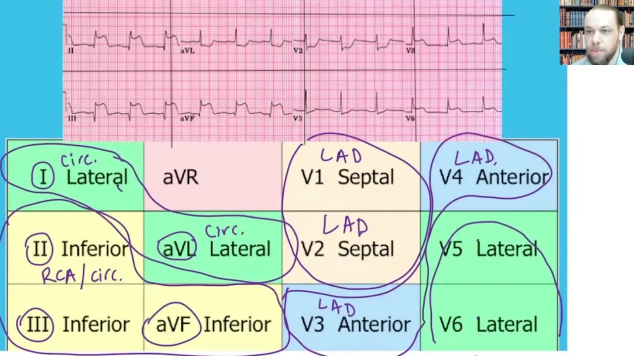 How to Interpret STEMI 12 Lead ECG and Correlate it with Coronary Arteries, 15 Lead EKG, Part 1