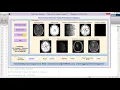 Brain Tumor Detection Using Watershed Technique Full Matlab Project Code