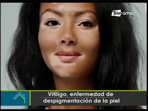 Vitíligo, enfermedad de despigmentación de la piel