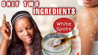 effective treatment for white patches white spot vitiligo u0026 uneven skin complexion whitepatches