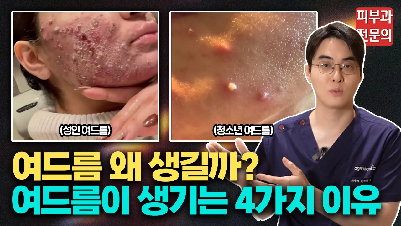 여드름 때문에 '이것' 생기게 되면 평생 완치가 힘듭니다 / 여드름 관리, 여드름 교정