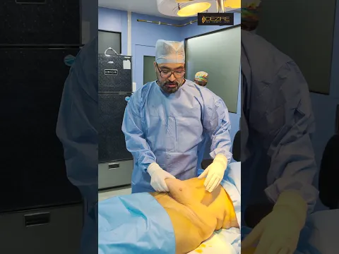 Tummy Tuck ?