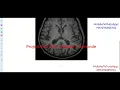 Types Of Brain Tumor Detection Using Image Processing Python Project With Source Code
