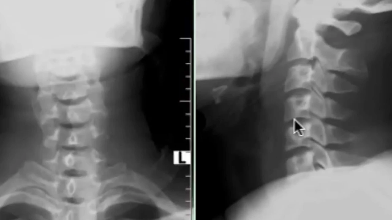 Educational video describing disc herniation and neck pain of the cervical spine. Cervical disc hern. 