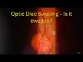 0089 Optic Disc Swelling - Is it Swollen