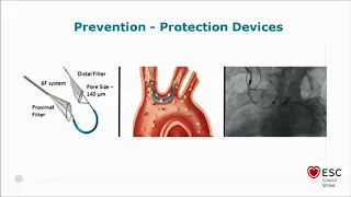 stroke due to cardiac interventions how big are the risks we take