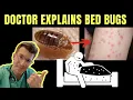 Doctor explains BED BUGS - including SYMPTOMS TREATMENT AND PREVENTION PHOTOS