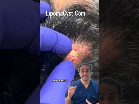 Dr Khaled explains what happens when leave cyst for too long| hair loss scarring disfiguration ￼