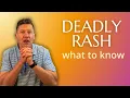 The Rash That Can Kill How to Spot Stevens-Johnson Syndrome Early