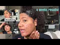 The Ordinary Peeling Solution Before After 4 weeks