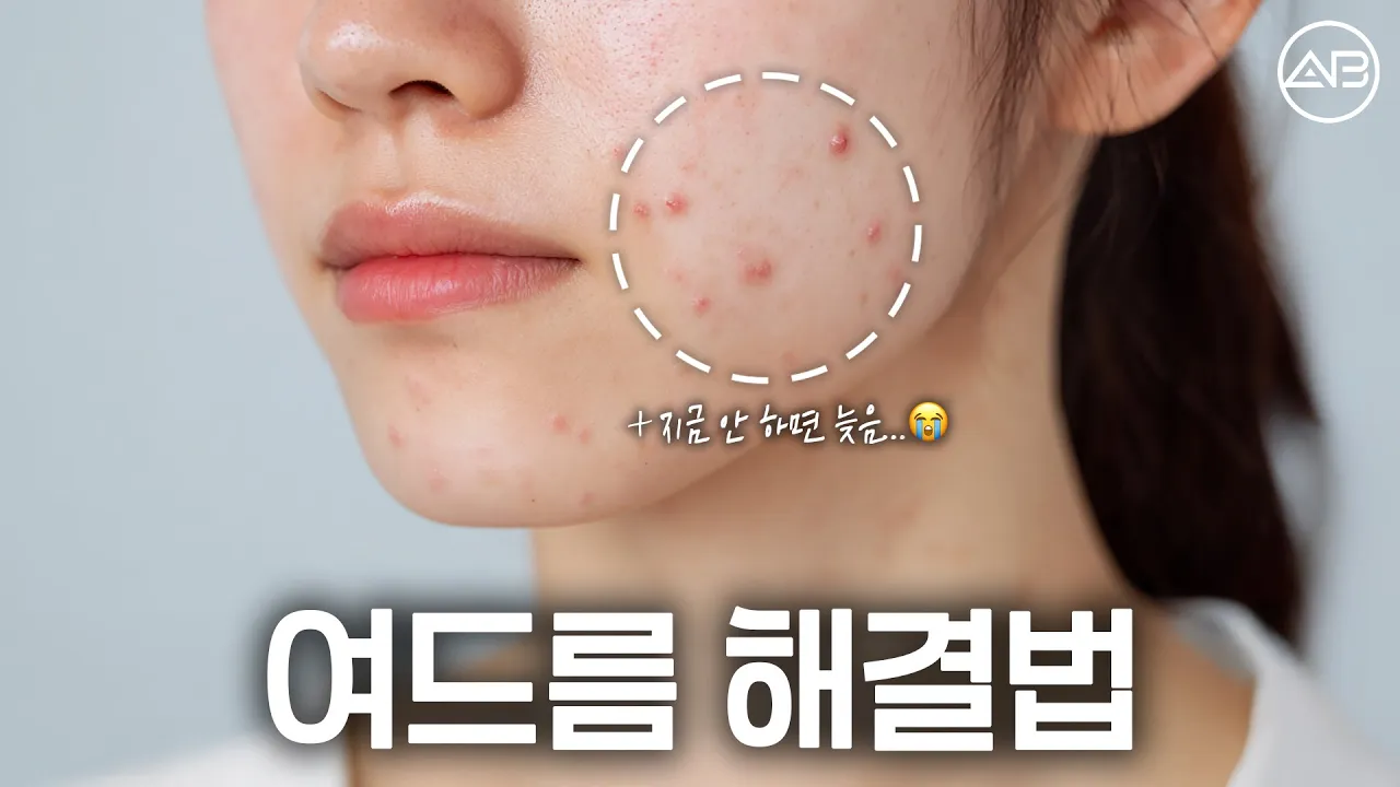지긋지긋한 여드름 해결 해보자💥