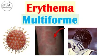 Erythema Multiforme: The "Target Rash" Every Healthcare Professional Should Recognize