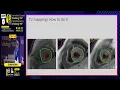 Download Lagu T1 \u0026 T2 Mapping in Cardiac MRI: Clinical Applications