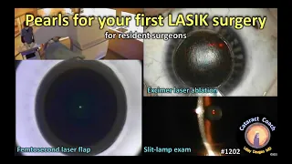 CataractCoach 1202 Pearls for your first LASIK surgery