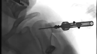 NIO Left Humerus Insertion 