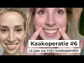Lagu KAAKOPERATIE - ALLES WAT JE WILT WETEN - 1,5 jaar na mijn operatie