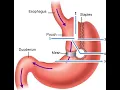 Vertical banded Gastroplasty CPT code - simplify medical coding
