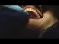 How popcorn lodged in a man s tooth almost killed him