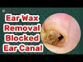 Download Lagu ASMR Ear Wax Removal - Ultimate Satisfying Clean - Up Session 2025 | Ear Cleaning 