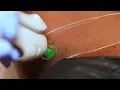 Download Lagu Brazilian Vagina Bikini Waxing | Micro Bikini Intimate waxing tutorial #hairremoval #bikiniwax 