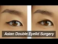 Asian Blepharoplasty Monolid to Double Eyelid Surgery