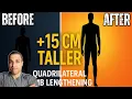 Download Lagu 15cm Taller with Cosmetic 'Quadrilateral' Limb Lengthening | Side Quest’s Transformation Story
