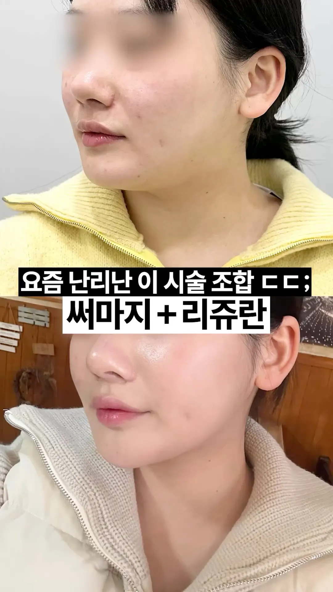 겨울엔 피부 시술 '이 조합' 하세요.