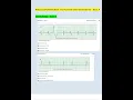 Relias Dysrhythmia Basic Test Answers 2023 2024 Dysrhythmia - Basic A Latest UPDATED Questions and
